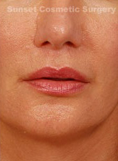Woman's lips, after Lip Lift and Lip Reduction treatment, front view, patient 64