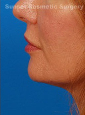 Woman's lips, after Lip Lift and Lip Reduction treatment, l-side view, patient 64