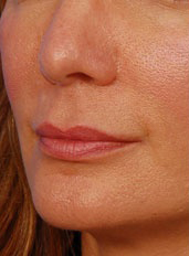 Woman's lips, before Lip Lift and Lip Reduction treatment, l-side oblique view, patient 64