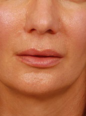 Woman's lips, before Lip Lift and Lip Reduction treatment, front view, patient 64