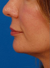 Woman's lips, before Lip Lift and Lip Reduction treatment, l-side view, patient 64