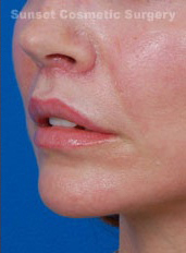 Woman's lips, after Lip Lift and Lip Reduction treatment, l-side oblique view, patient 67