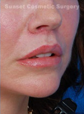 Woman's lips, after Lip Lift and Lip Reduction treatment, r-side oblique view, patient 67
