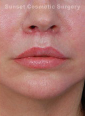 Woman's lips, after Lip Lift and Lip Reduction treatment, front view (lips closed), patient 67