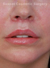 Woman's lips, after Lip Lift and Lip Reduction treatment, front view, patient 67