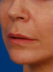 Woman's lips, before Lip Lift and Lip Reduction treatment, l-side oblique view, patient 67