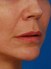 Woman's lips, before Lip Lift and Lip Reduction treatment, r-side oblique view, patient 67
