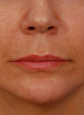 Woman's lips, before Lip Lift and Lip Reduction treatment, front view (lips closed), patient 67