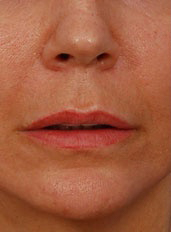 Woman's lips, before Lip Lift and Lip Reduction treatment, front view, patient 67