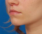 Woman's lips, after Lip Lift and Lip Reduction treatment, l-side oblique view, patient 7