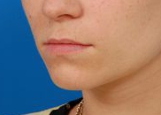 Woman's lips, before Lip Lift and Lip Reduction treatment, l-side oblique view, patient 7