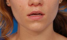 Woman's lips, after Lip Lift and Lip Reduction treatment, front view, patient 7