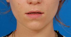 Woman's lips, before Lip Lift and Lip Reduction treatment, front view, patient 7