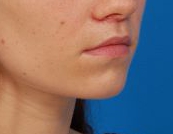 Woman's lips, after Lip Lift and Lip Reduction treatment, r-side oblique view, patient 7