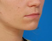 Woman's lips, before Lip Lift and Lip Reduction treatment, r-side oblique view, patient 7