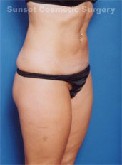 Woman's body, after Liposuction treatment, r-side oblique view, patient 1