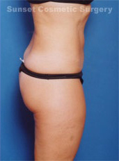 Woman's body, after Liposuction treatment, r-side view, patient 1