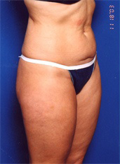 Woman's body, before Liposuction treatment, r-side oblique view, patient 1