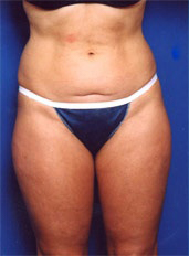 Woman's body, before Liposuction treatment, front view, patient 1