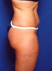 Woman's body, before Liposuction treatment, r-side view, patient 1