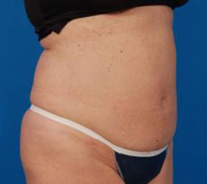 Woman's body, after Liposuction treatment, r-side oblique view, patient 10