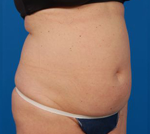 Woman's body, before Liposuction treatment, r-side oblique view, patient 10