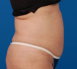 Woman's body, after Liposuction treatment, r-side view, patient 10