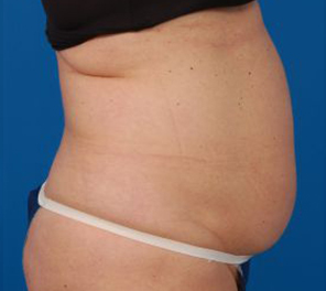 Woman's body, before Liposuction treatment, r-side view, patient 10
