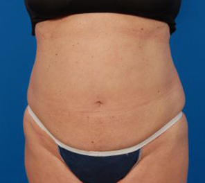Woman's body, after Liposuction treatment, front view, patient 10