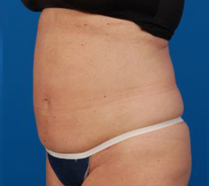 Woman's body, after Liposuction treatment, l-side oblique view, patient 10