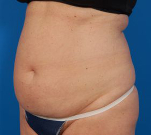 Woman's body, before Liposuction treatment, l-side oblique view, patient 10