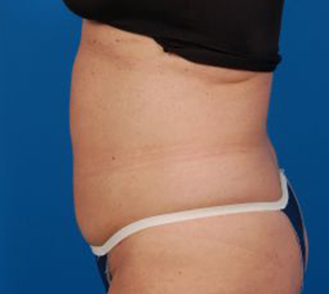 Woman's body, after Liposuction treatment, l-side view, patient 10