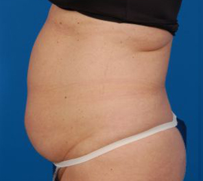 Woman's body, before Liposuction treatment, l-side view, patient 10
