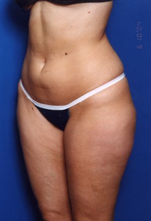 Woman's body, before Liposuction treatment, l-side oblique view, patient 11