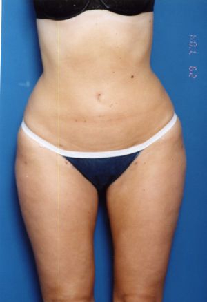 Woman's body, after Liposuction treatment, front view, patient 11