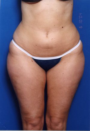 Woman's body, before Liposuction treatment, front view, patient 11