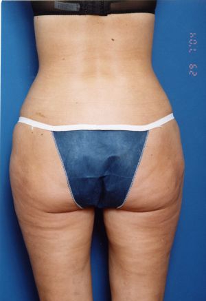 Woman's body, after Liposuction treatment, b-side view, patient 11