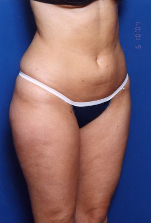 Woman's body, before Liposuction treatment, r-side oblique view, patient 11