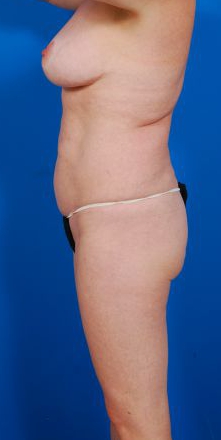 Woman's body, before Liposuction treatment, l-side view, patient 12