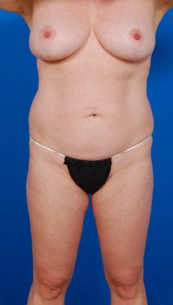Woman's body, before Liposuction treatment, front view, patient 12