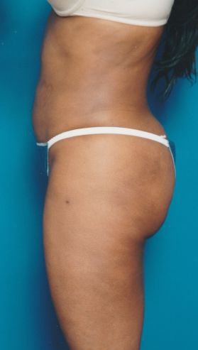 Woman's body, after Liposuction treatment, l-side view, patient 13