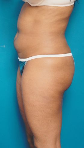 Woman's body, before Liposuction treatment, l-side view, patient 13