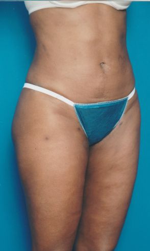 Woman's body, after Liposuction treatment, r-side oblique view, patient 13
