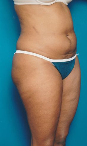 Woman's body, before Liposuction treatment, r-side oblique view, patient 13
