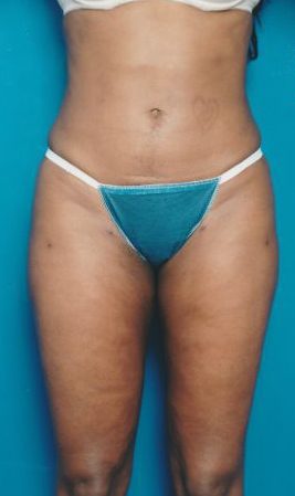 Woman's body, after Liposuction treatment, front view, patient 13