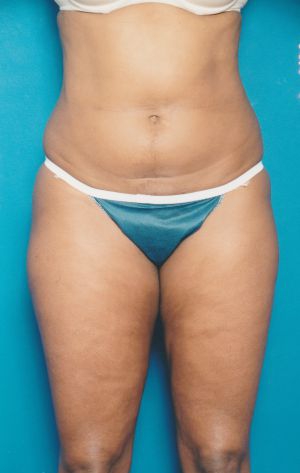 Woman's body, before Liposuction treatment, front view, patient 13