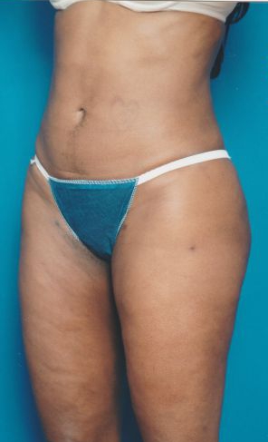Woman's body, after Liposuction treatment, l-side oblique view, patient 13