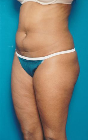 Woman's body, before Liposuction treatment, l-side oblique view, patient 13