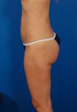 Woman's body, after Liposuction treatment, l-side view, patient 30