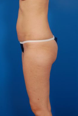 Woman's body, before Liposuction treatment, l-side view, patient 30